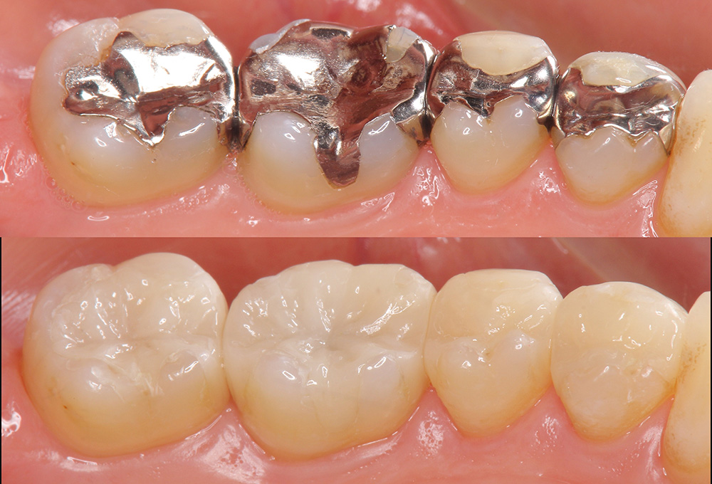 予防型の審美歯科