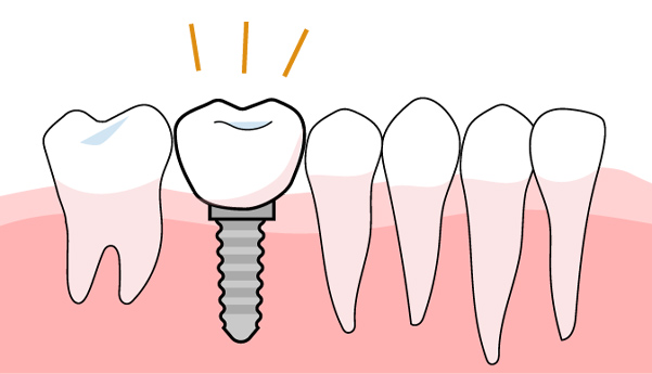 インプラント